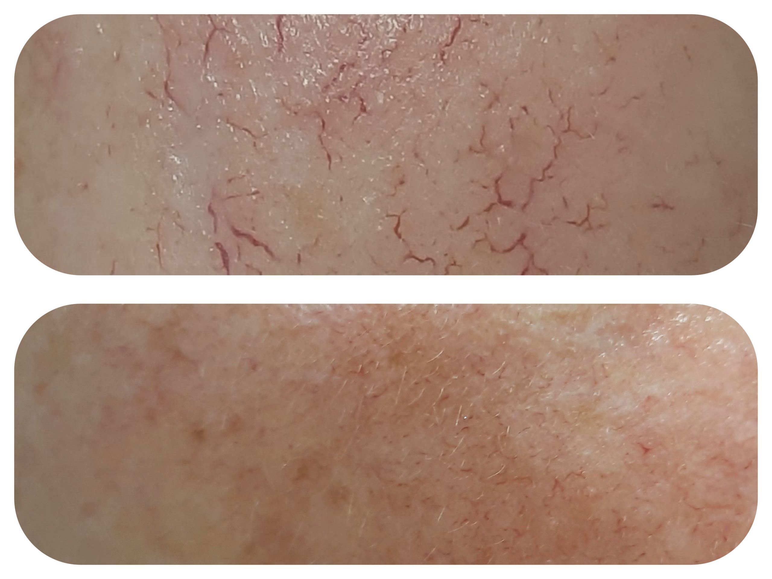 laser-azul-maitestyle laser-azul-maitestyle