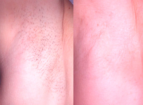 axila-depilación-laser