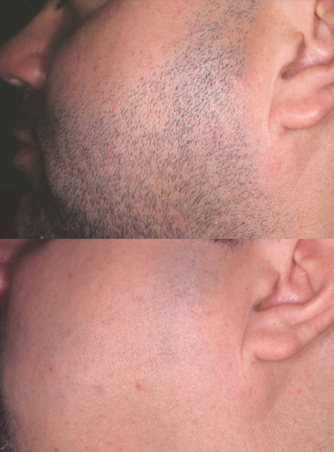 depilacion-laser-maite-aranda