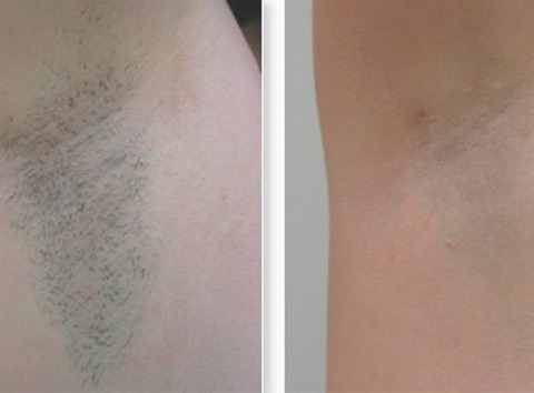 depilacion-laser-maite-aranda