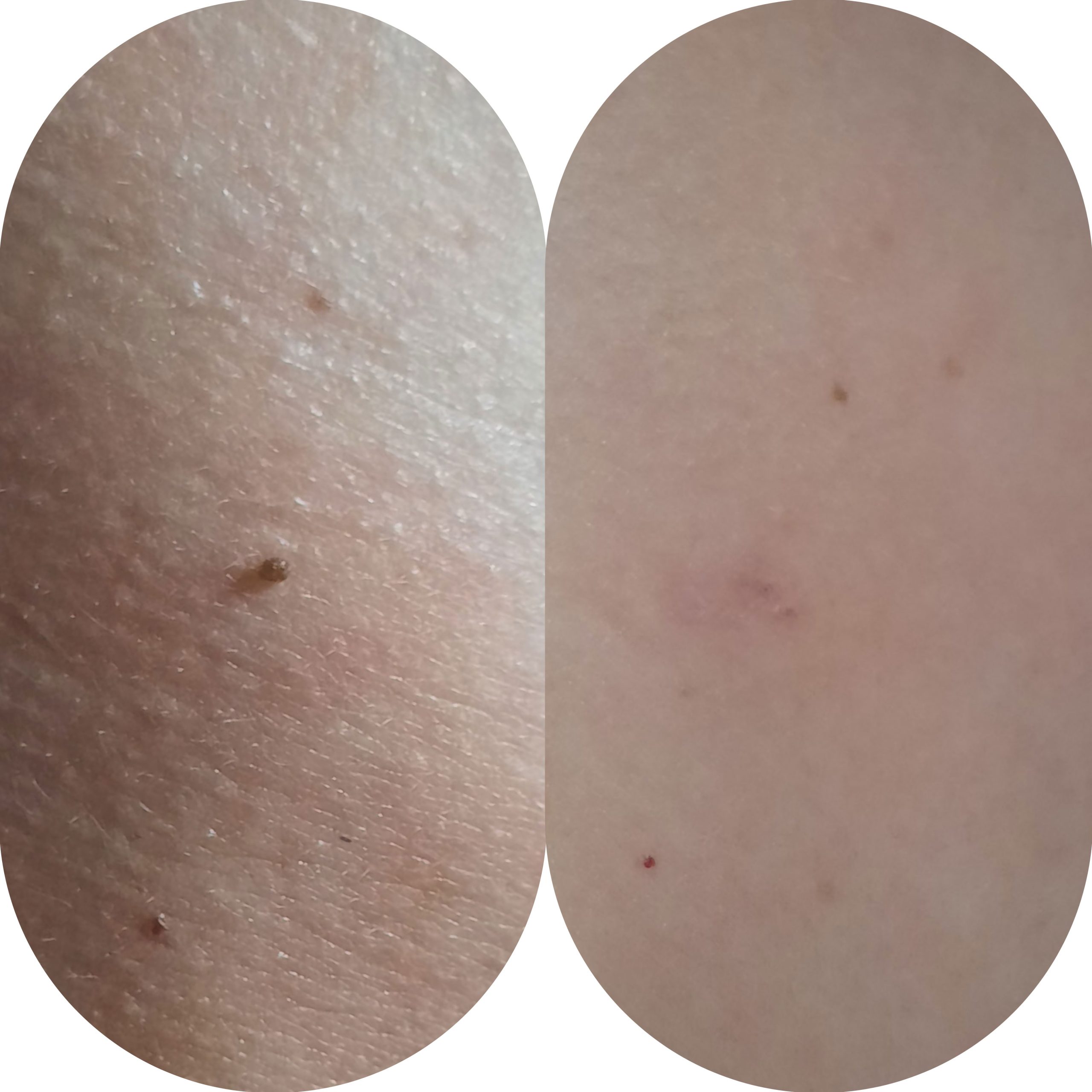 laser-azul-maitestyle laser-azul-maitestyle