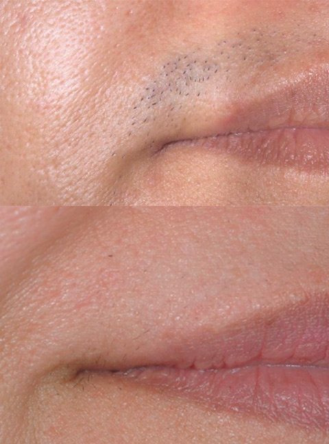 depilacion-laser-maite-aranda