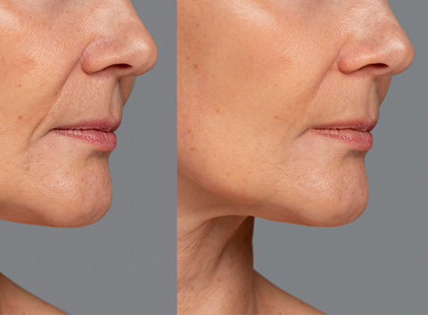 rejuvenecmiento-maitestyle